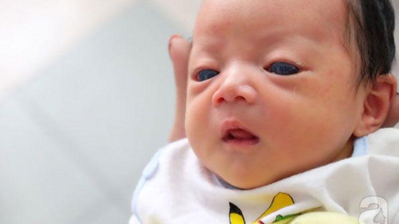 Đục thủy tinh thể dễ dẫn đến mù lòa ở trẻ