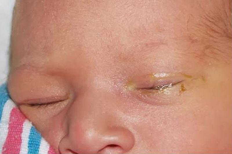 Bệnh viêm kết mạc xuất phát từ virus - vi khuẩn